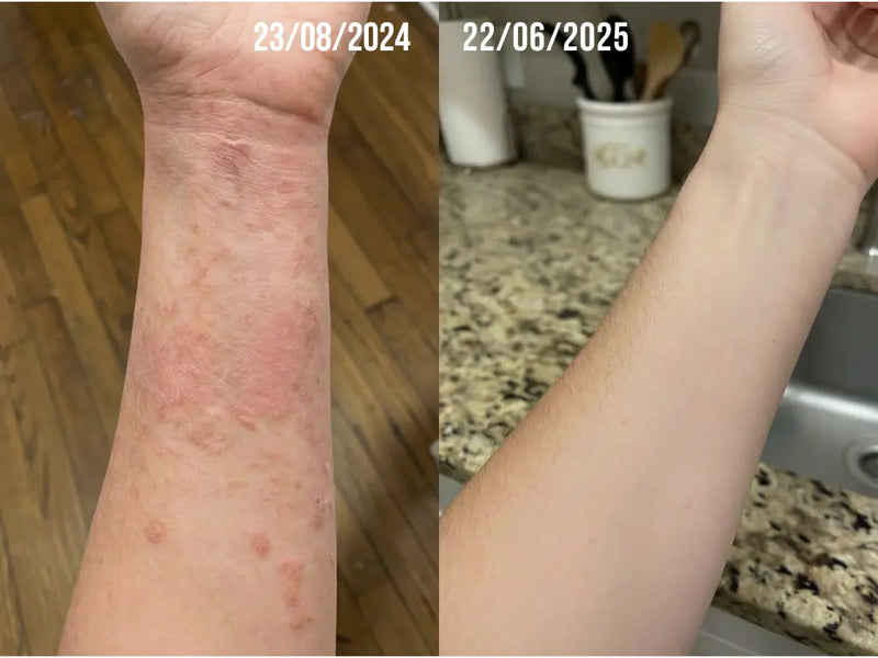 Eczema relief